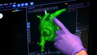 Atrial Appendage during LARIAT procedure