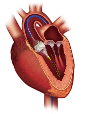 TAVR transcatheter aortic valve replacement